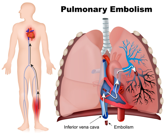 Pulmonary Embolism Lawsuits